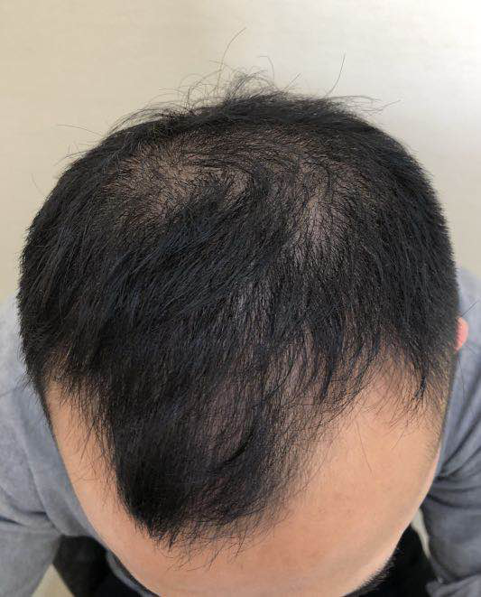 【私信问答】:度他雄胺可以治疗男性脱发吗?