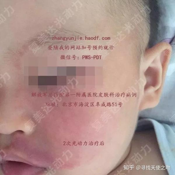 鲜红斑痣复美达光动力治疗痊愈基痊愈病例展示部分