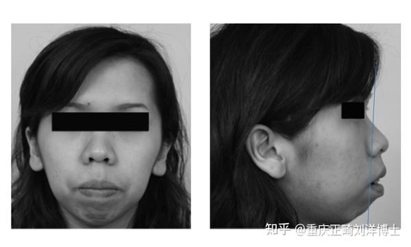 典型的双颌前突患者,静止状态下呈现开唇露齿,双唇无法自然闭拢,唇部