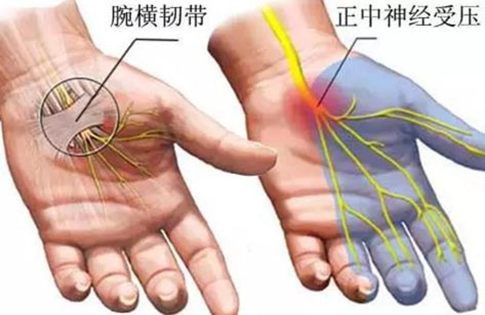 手指麻木手部肌肉萎缩可能是这个原因腕管综合征是什么病