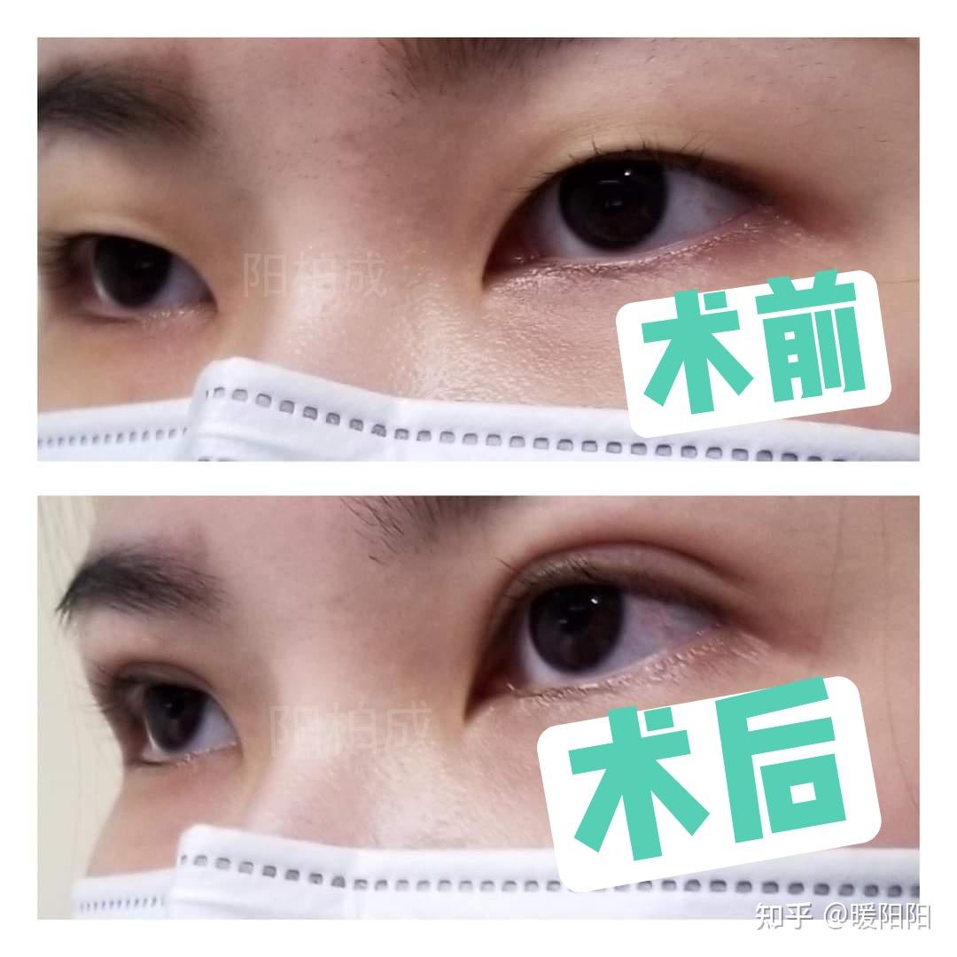 【案例分享】同一个人单眼皮和双眼皮对比