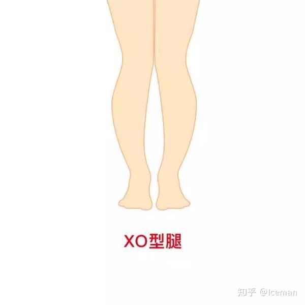 xo型腿纠正