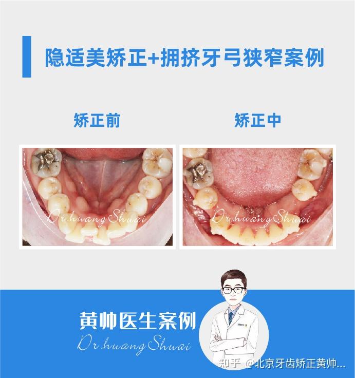 成年人牙齿矫正可以扩弓吗
