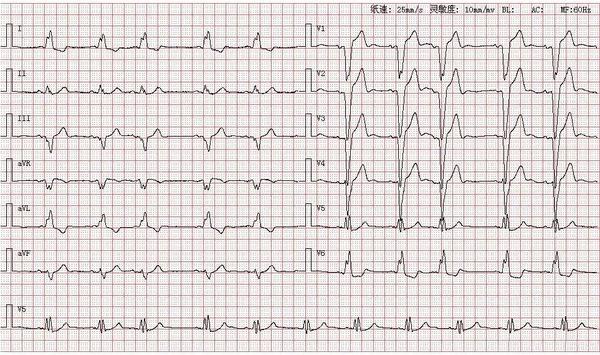 心电图图库丨完全性左束支阻滞系列