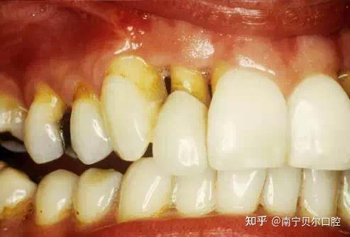 牙齿敏感是怎么回事会有什么影响吗