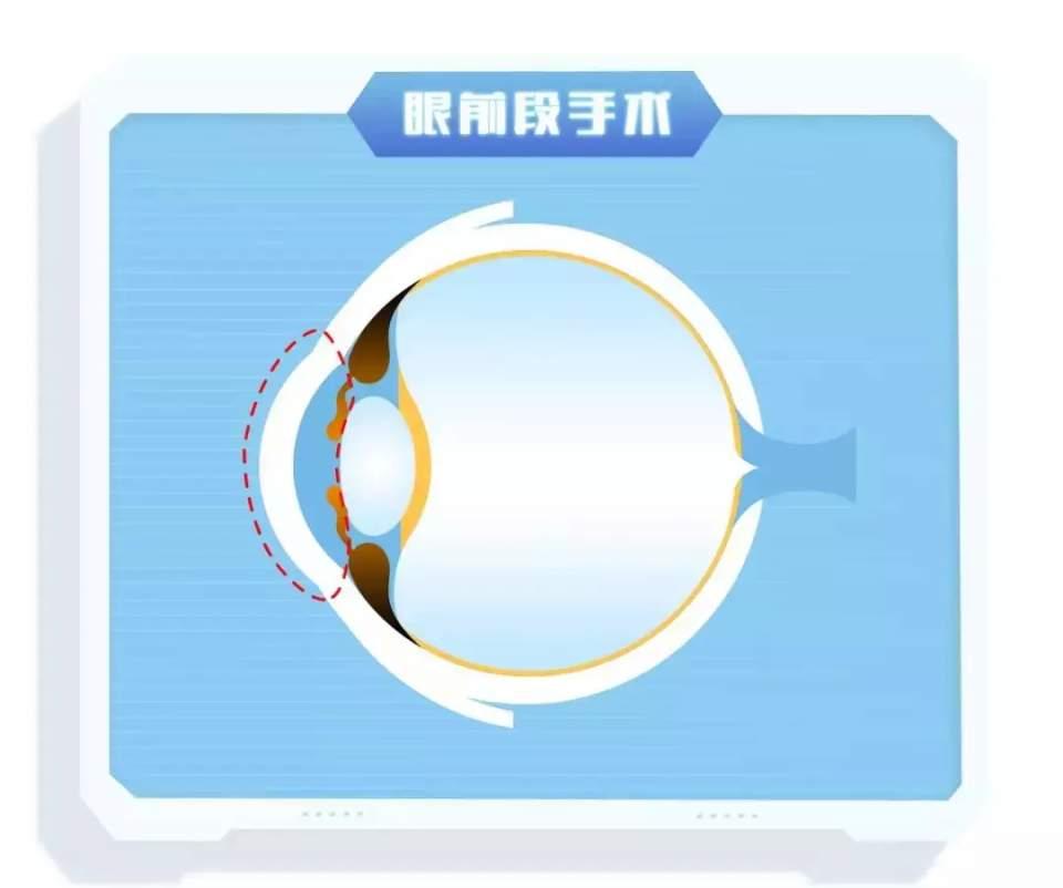 激光近视手术到底动了眼睛的哪个部分?