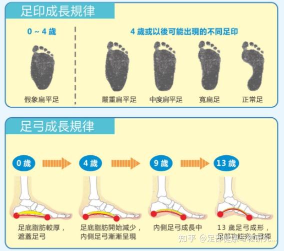 家长应该了解的儿童下肢发育现象:扁平足,足外翻,o型腿