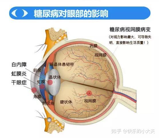 糖尿病眼底并发症要是预防好将减少70%以上