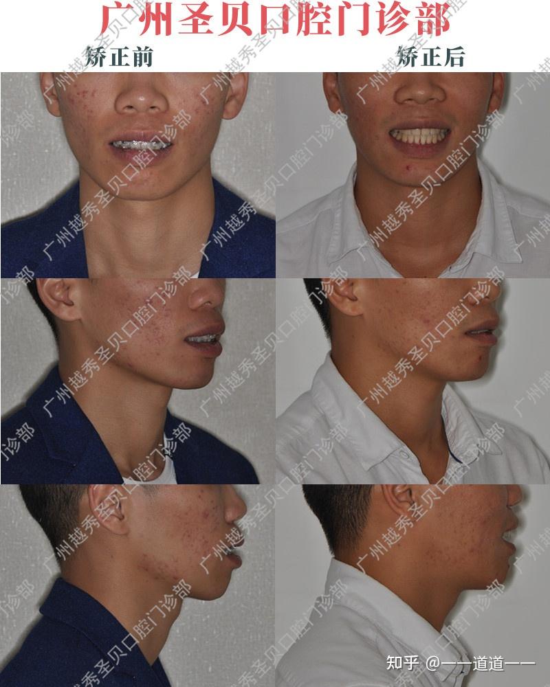 广州圣贝蔡菁菁医生牙齿矫正案例分享错颌畸形双颌前突治疗