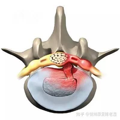 腰椎间盘突出患者的日常生活是一种怎样的体验?