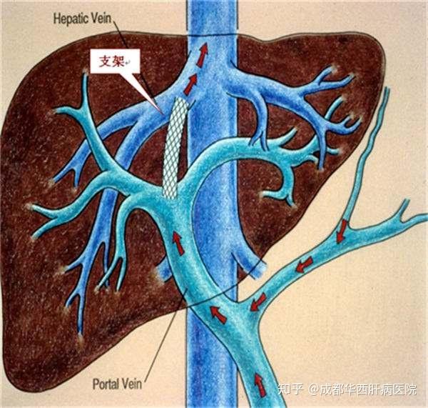 知乎热门话题胃出血静脉曲张是一种什么样的病