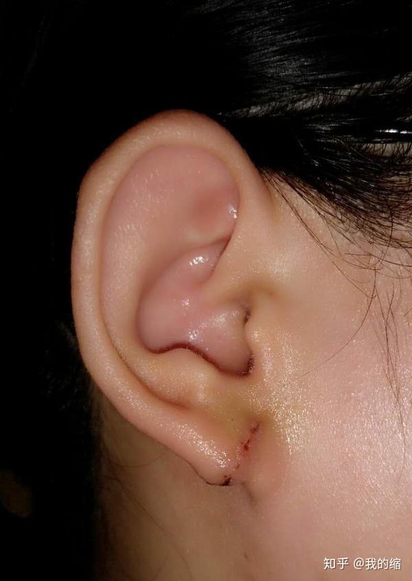 耳洞瘢痕疙瘩治疗记录