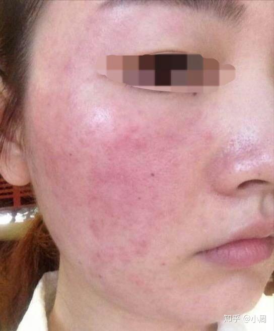 激素脸的常见表现一般为:初期症状与过敏无二,主要表现为泛红,发胀