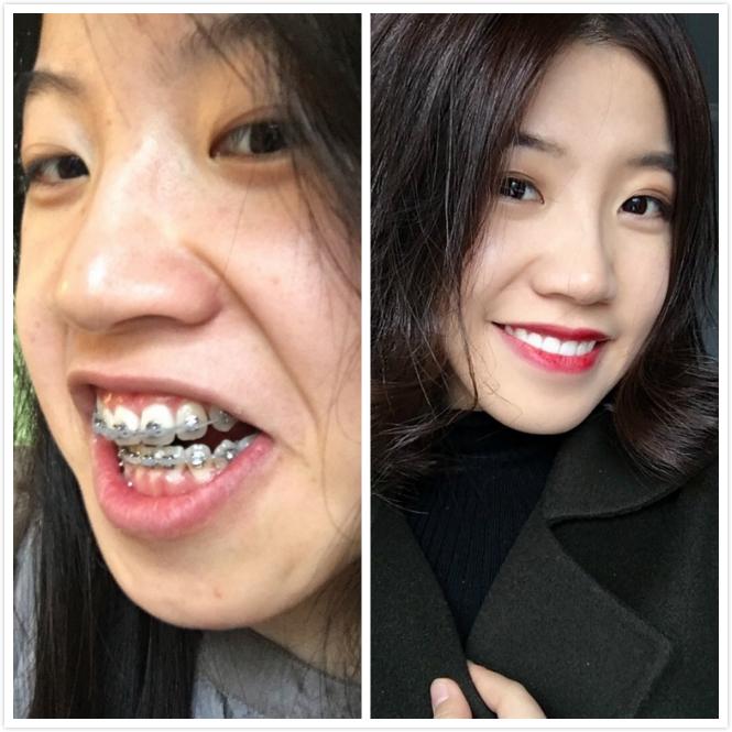 正畸分享 戴牙套三年,中途换了医生,终于是一口漂亮的大白牙