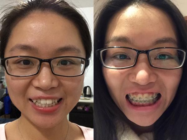 25 岁后去矫正牙齿(带牙套)是什么体验?