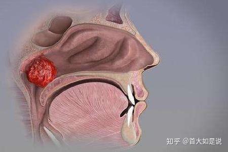 首大石萍:腺样体切除术是如何进行的