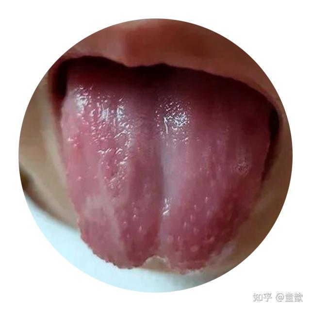孩子的舌苔属于地图舌吗