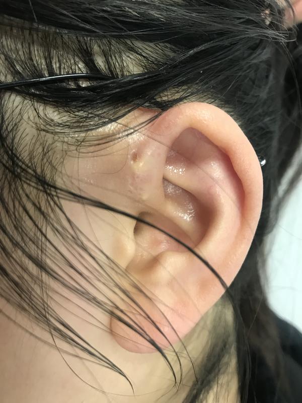 耳前瘘管发炎引流切除全过程亲身记录