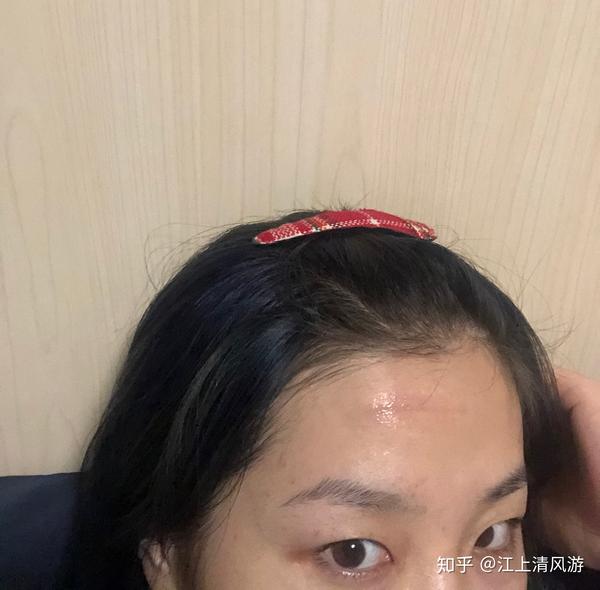 非美容缝合后的抗疤之路