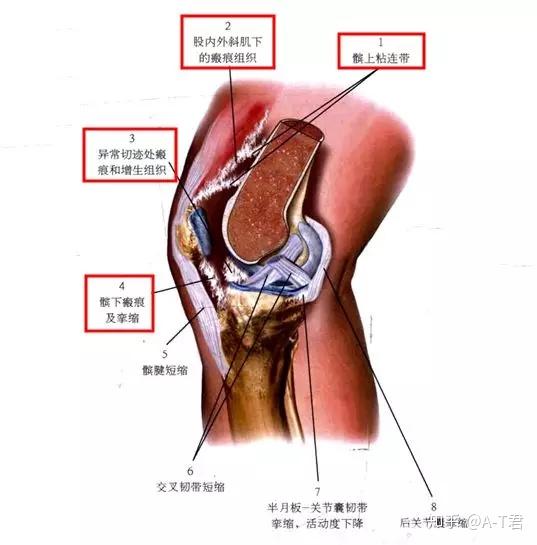 (参考上图) 1 髌上粘连带长时间粘连容易出现股四头肌长度缩短,影响