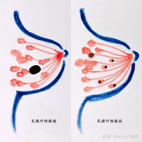 2发病机制不同 乳腺纤维腺瘤:一般与性激素水平失衡,乳腺局部组织对雌