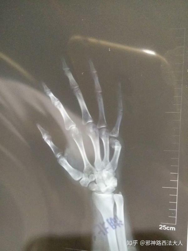 16年8月做的右手第五掌骨闭合复位手术. 附一张当时的x光片.