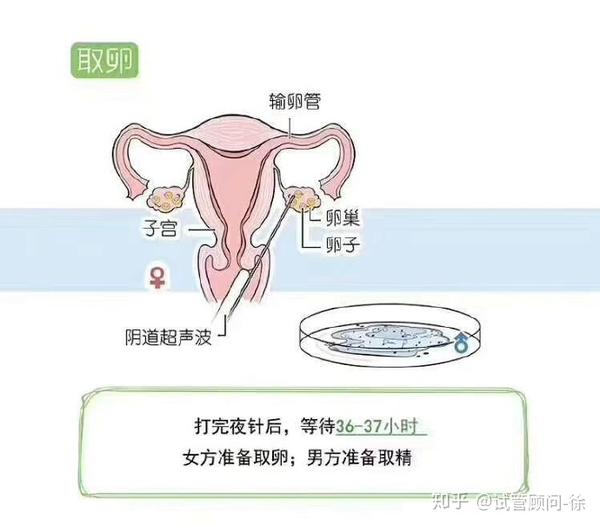 选择在注射镇痛药下或静脉麻醉下经阴道b超引导,将取卵针穿过阴道穹窿