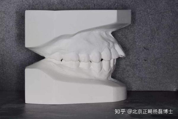 牙齿石膏模型