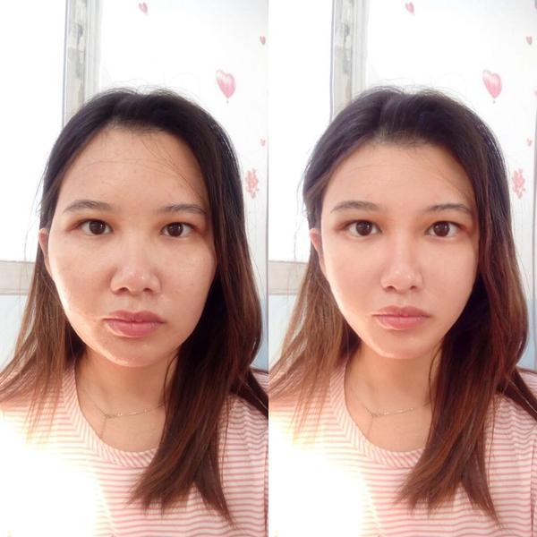 凹陷加内双肿泡眼,我的眼睛该怎么整?