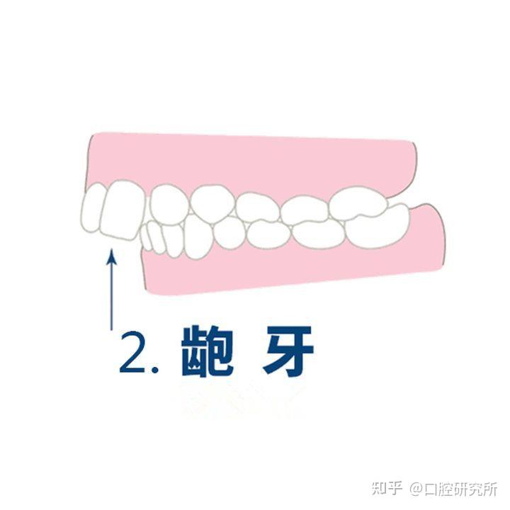 科普tips常见的几种牙齿畸形你是哪一种