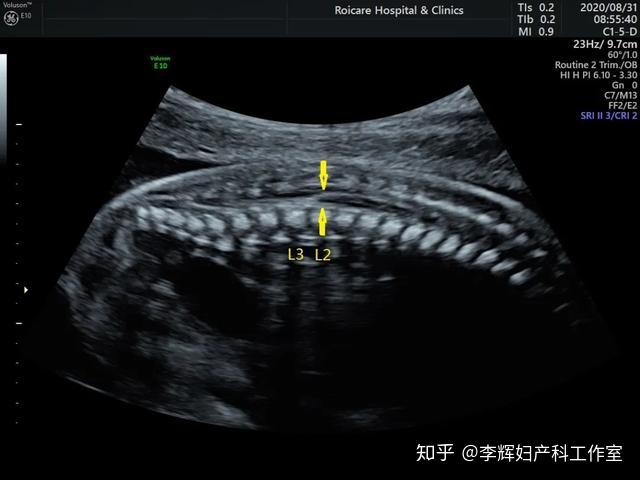 胎儿期发现脊髓圆锥位置低的临床指导