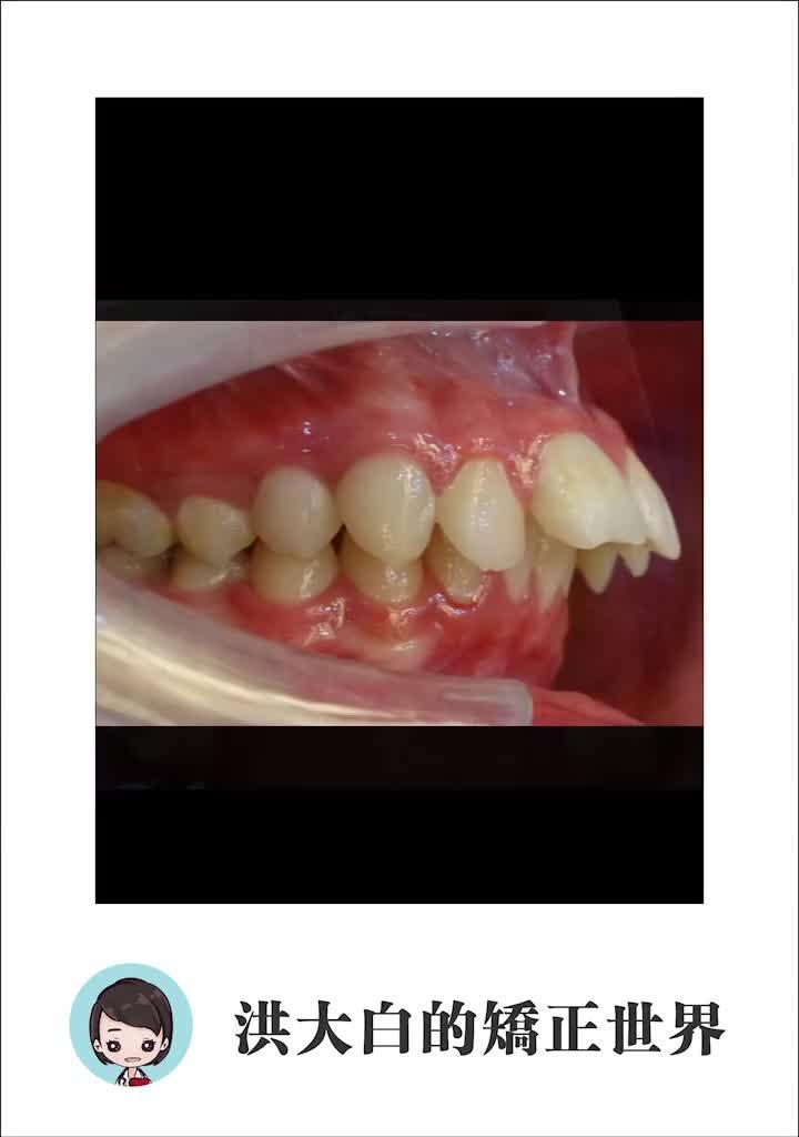 青少年二类尖牙和磨牙关系病例,拔牙or不拔牙?