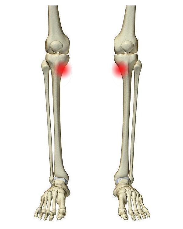跑完步,左腿膝盖胫骨内侧痛怎么办?