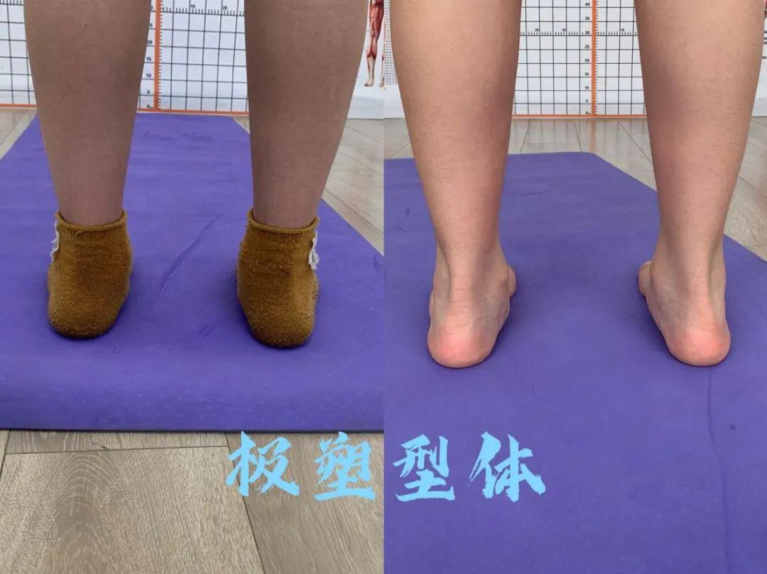 身体解读*足跟相对小腿内倾*足部相对小腿外旋*胫骨相对股骨外旋调整
