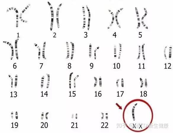 少了条x染色体的女性,称为 turner综合征,核型为(45,xo).