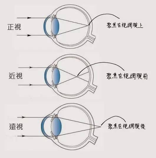 儿童眼球发展的过程可以分为以下几个阶段:生理性远视,正视,近视.