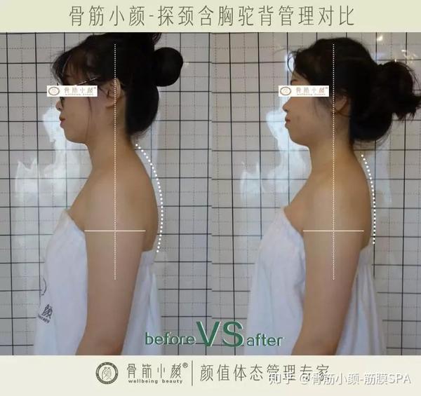 适用人群:含胸驼背,圆肩,大椎包,翼状肩胛骨,脊椎侧弯,高低肩等背部