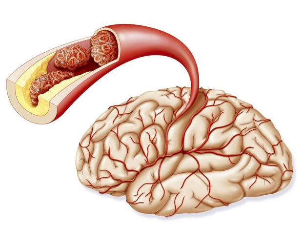 原因在于,当我们的大脑血管堵塞,眼部的微血管也会出现供血不足,因此