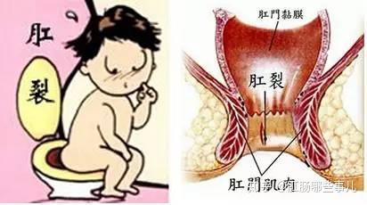 肛门疼,是菊花出问题了吗?