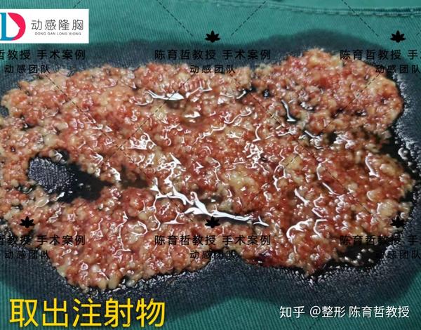 脂肪"营养"供应不上,造成脂肪不成活,变质,坏死!