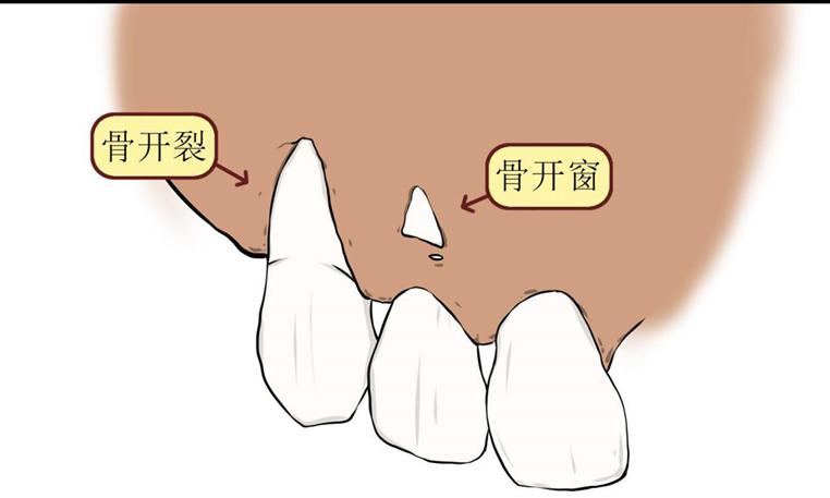 什么是骨开窗是正畸导致的吗看看骨开窗该如何治疗