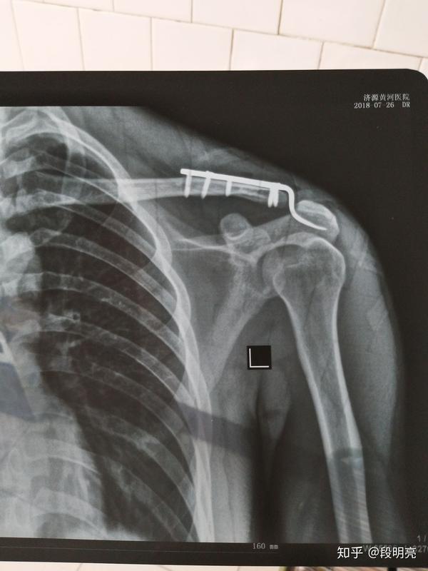 肩锁关节脱位术后放置锁骨钩一个半月了,为什么慢跑时