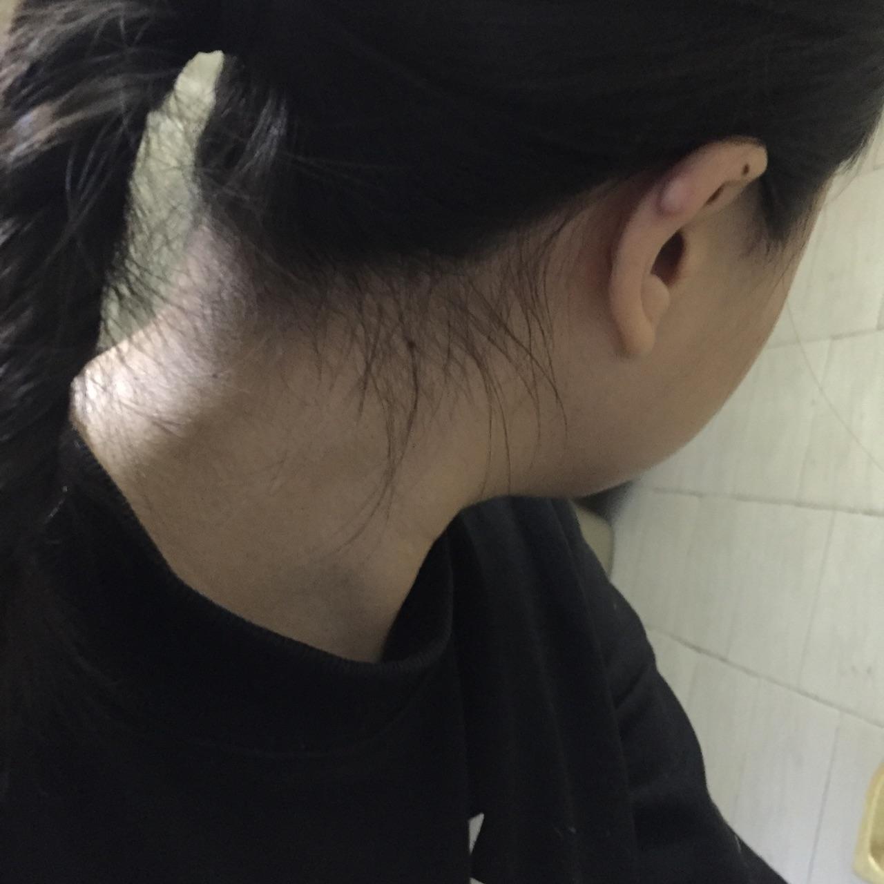 耳洞长好以后原处里面有个硬块是什么