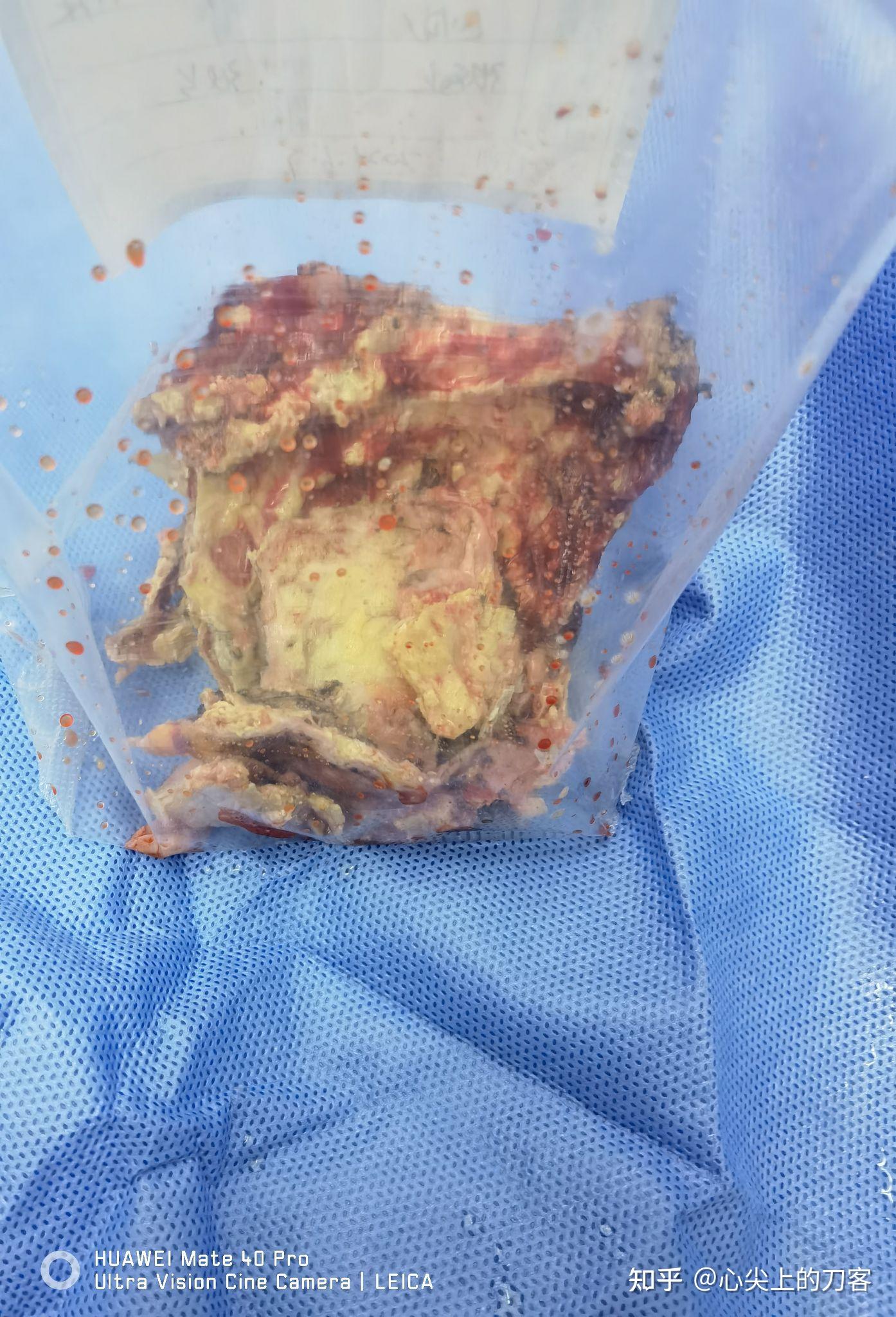 瓣膜上的赘生物可由超声心动图探得,尤在血培养阳性的感染性心内膜炎