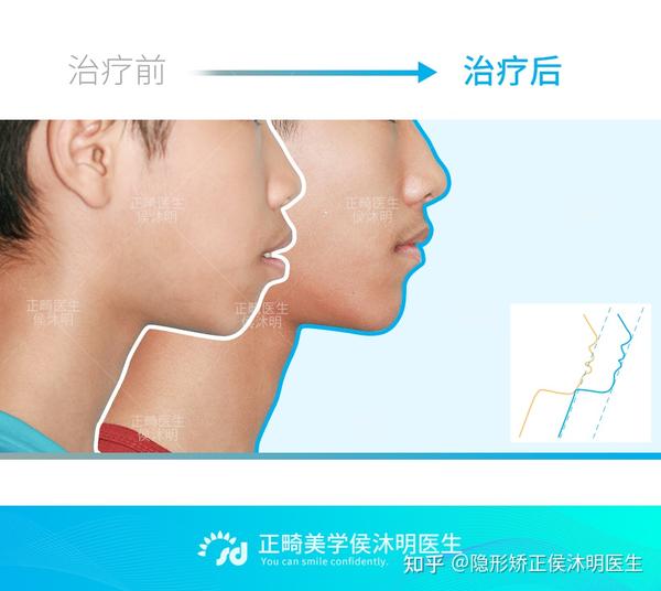 青少年口呼吸凸嘴龅牙矫正案例