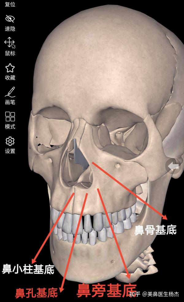 鼻基底凹陷的分类以及手术治疗