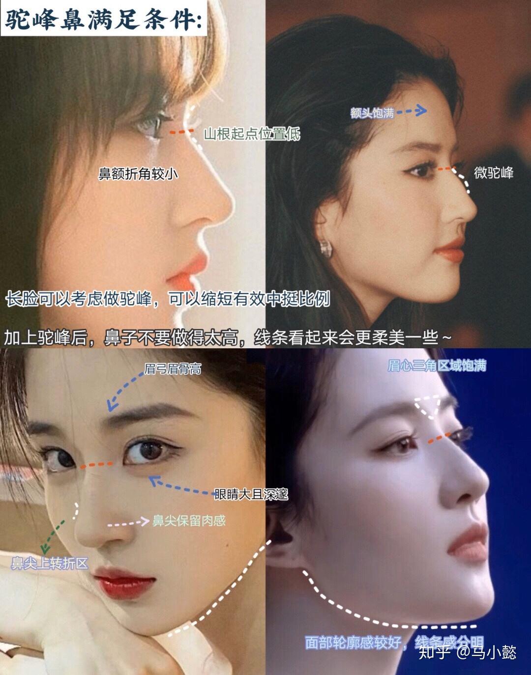 隆鼻审美微驼峰鼻最全功课全国擅长驼峰鼻的隆鼻医生盘点附案例