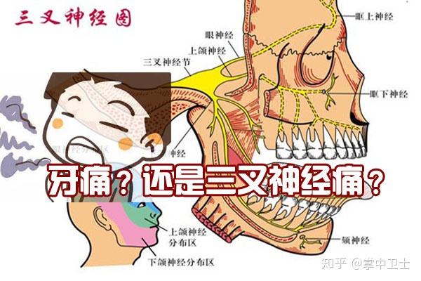 三叉神经痛拖延难忍八哥发作时,切忌盲目乱治或反复疼痛电影在线看图片