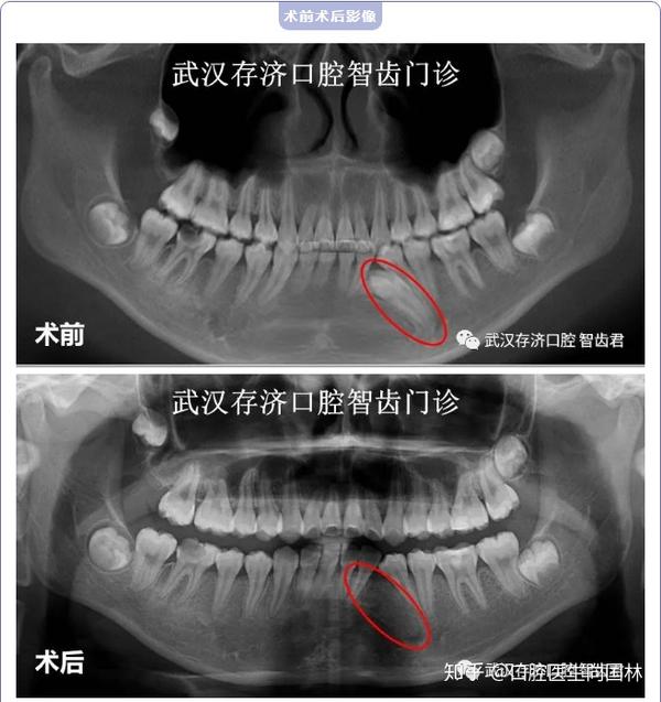 【案例】15岁女孩做牙齿矫正,竟然检查出大问题?