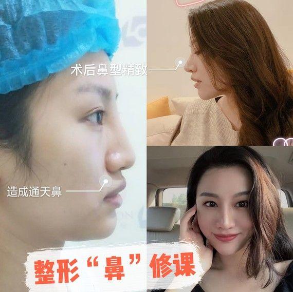 塌鼻梁问题:主要表现为山根低平,鼻背曲线不够自然,从而影响面部